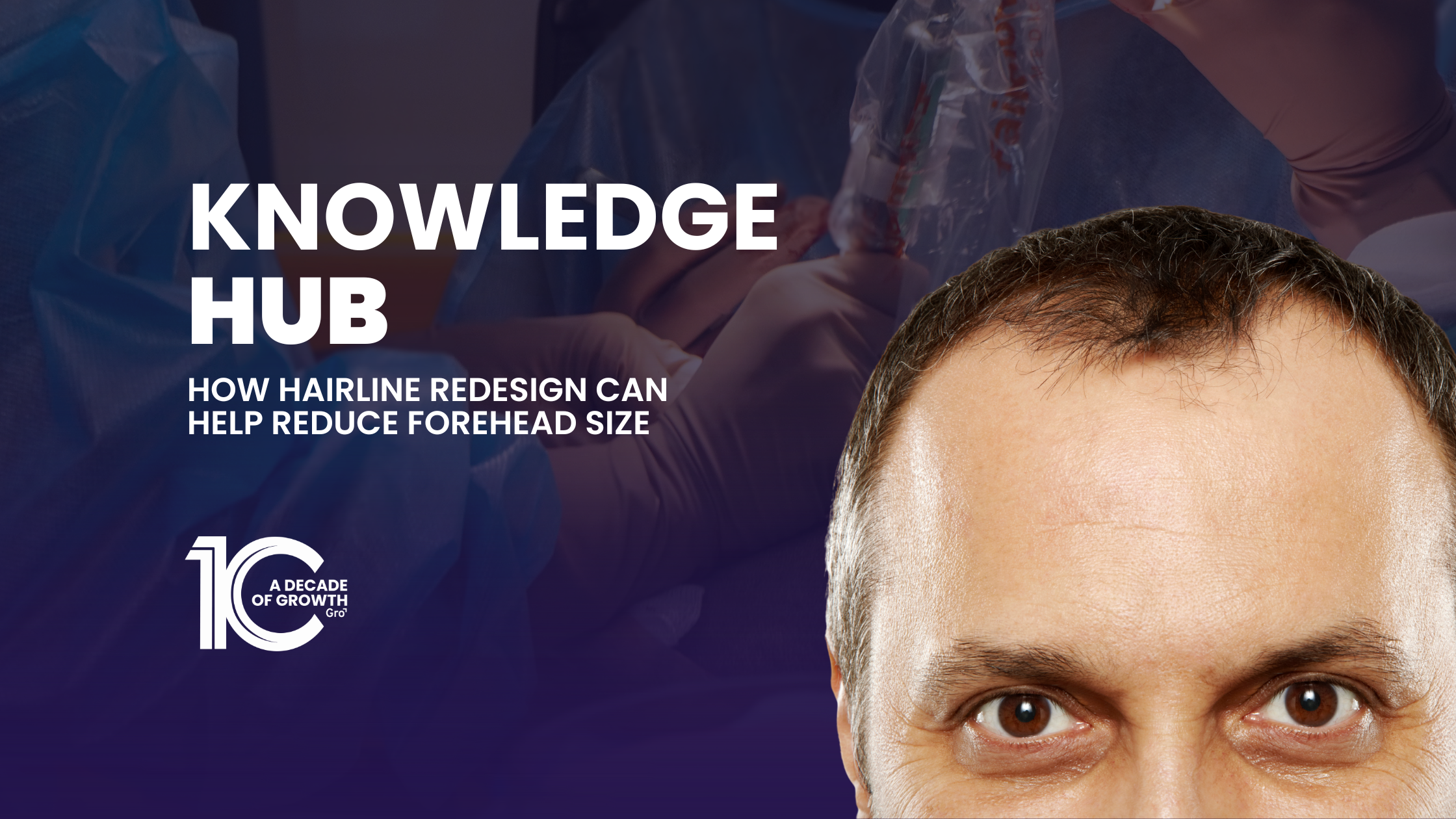 How Hairline Redesign Can Help Reduce Forehead Size