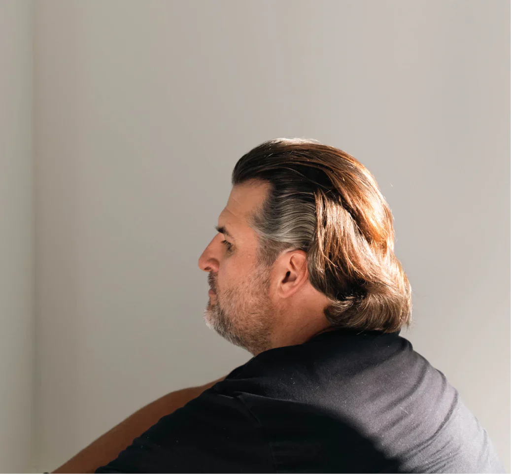 Mature Hairline vs Receding Hairline: Signs, Stages & Treatment