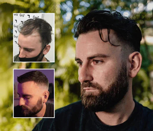 Hair Plugs Explained: What They Are vs Modern Hair Transplants