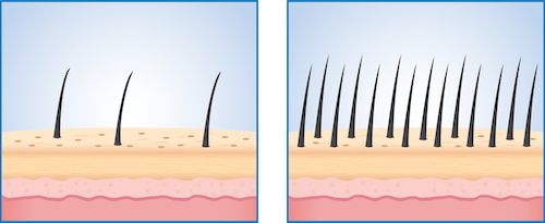 How Many Grafts Are Needed For A Good Hair Transplant?