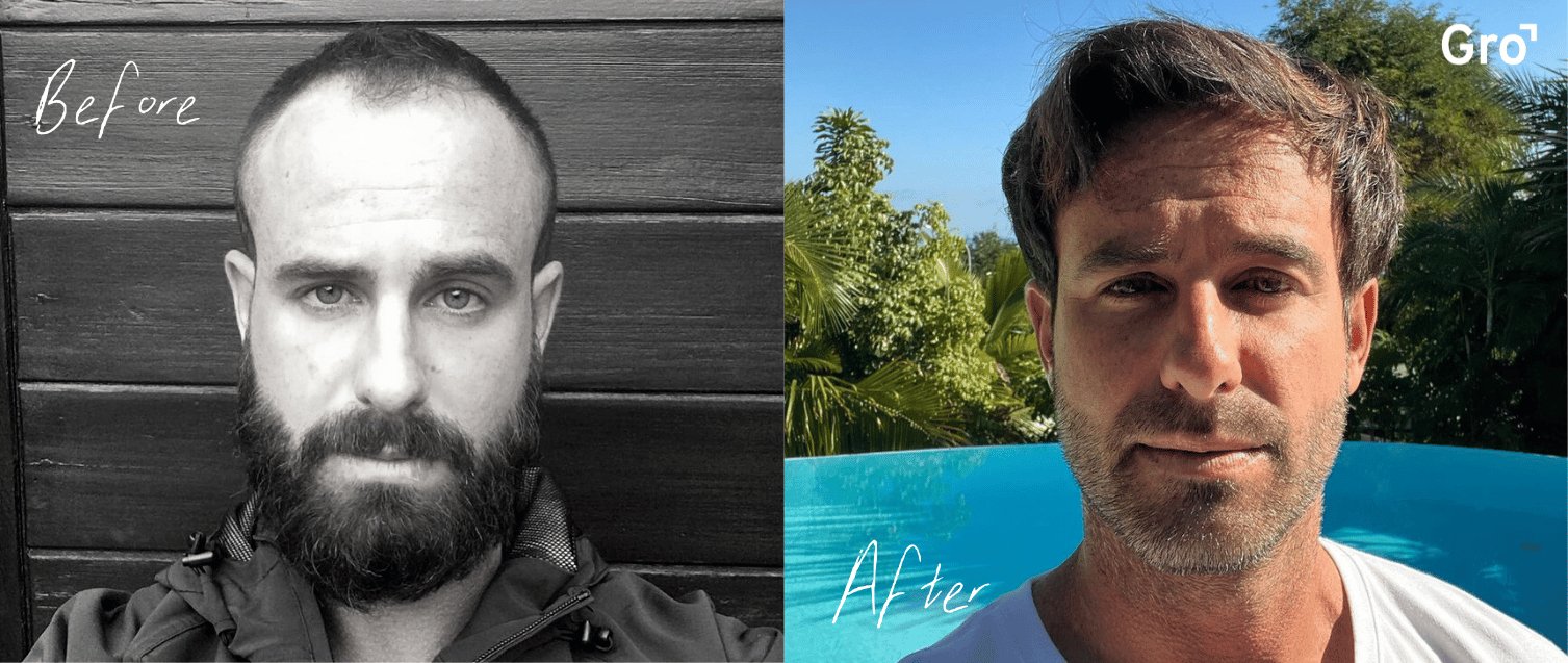 The Head Hair vs Beard Hair Connection