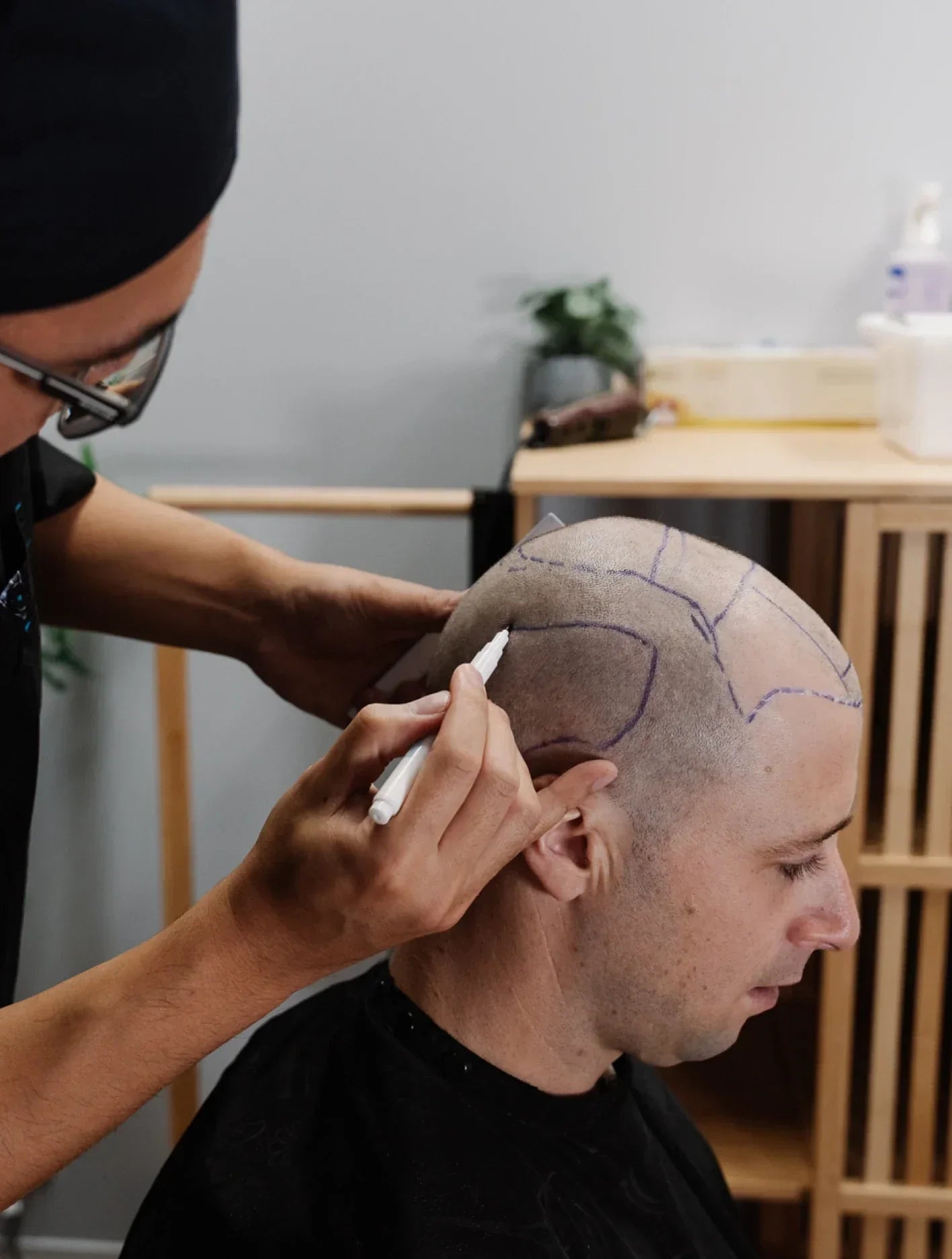 Hair Transplant Swelling: Causes, Treatment, & More