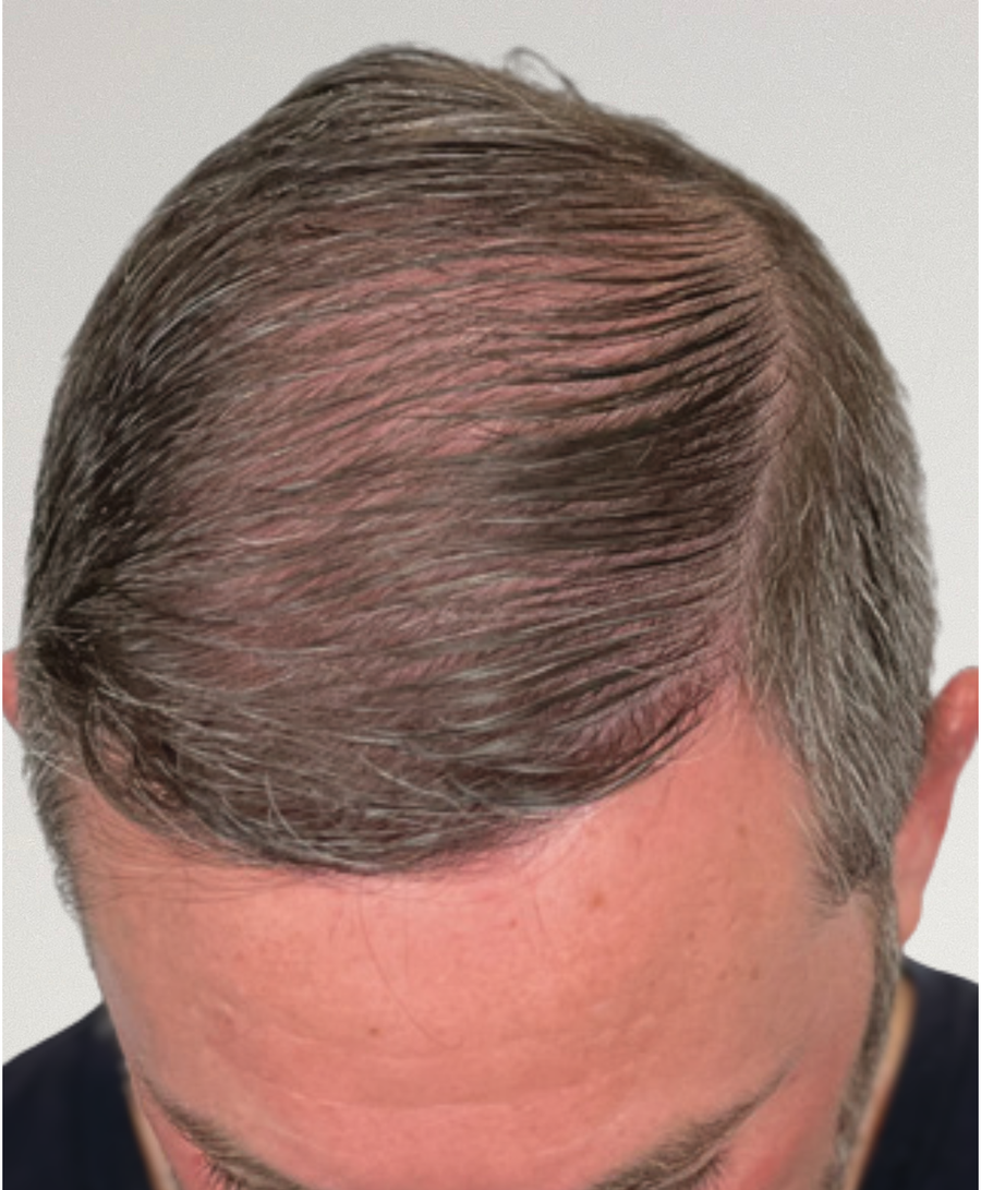 The same patient 12 months, treated by Dr Diana Phan