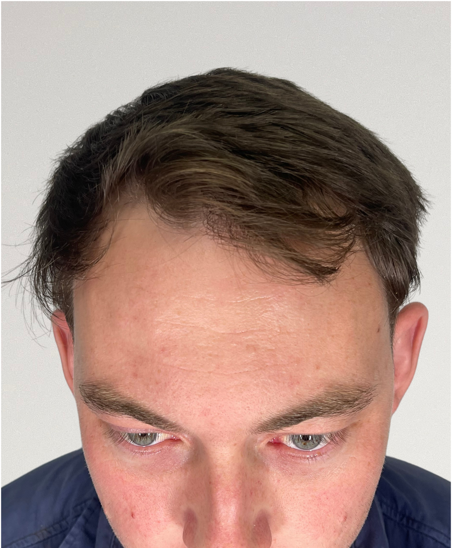 Hair restoration patient before treatment, receding hairline