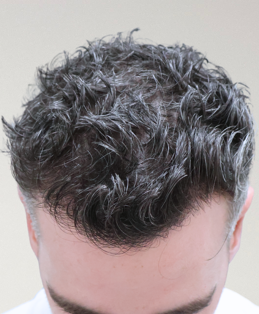 The same patient 10 months, treated by Dr David Ballantyne