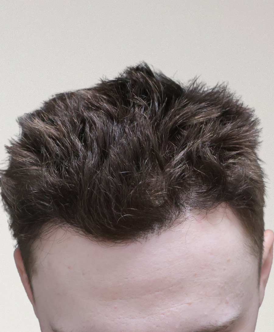 The same patient 6 months, treated by Dr David Ballantyne