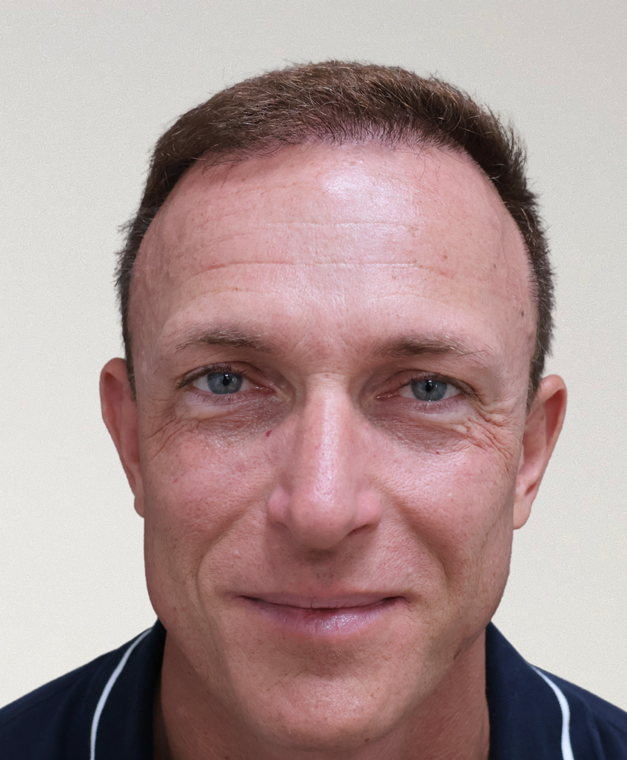The same patient 6 months, treated by Dr David Ballantyne