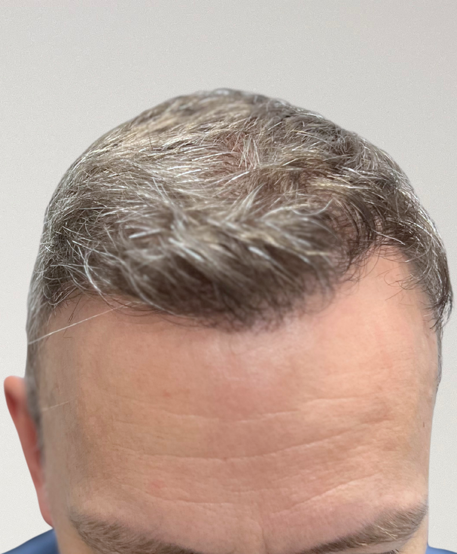 The same patient 10 months , treated by Dr David Ballantyne