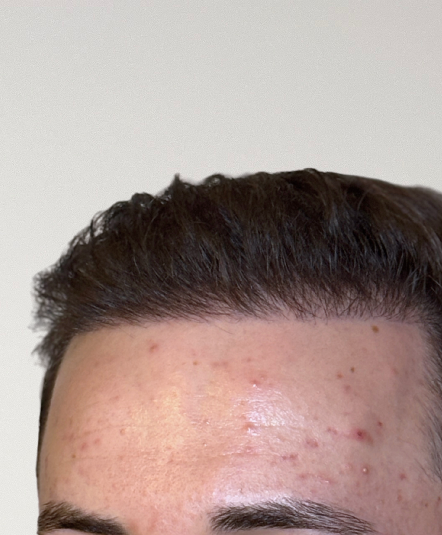 The same patient 6 Months, treated by Dr Hisham Khalid
