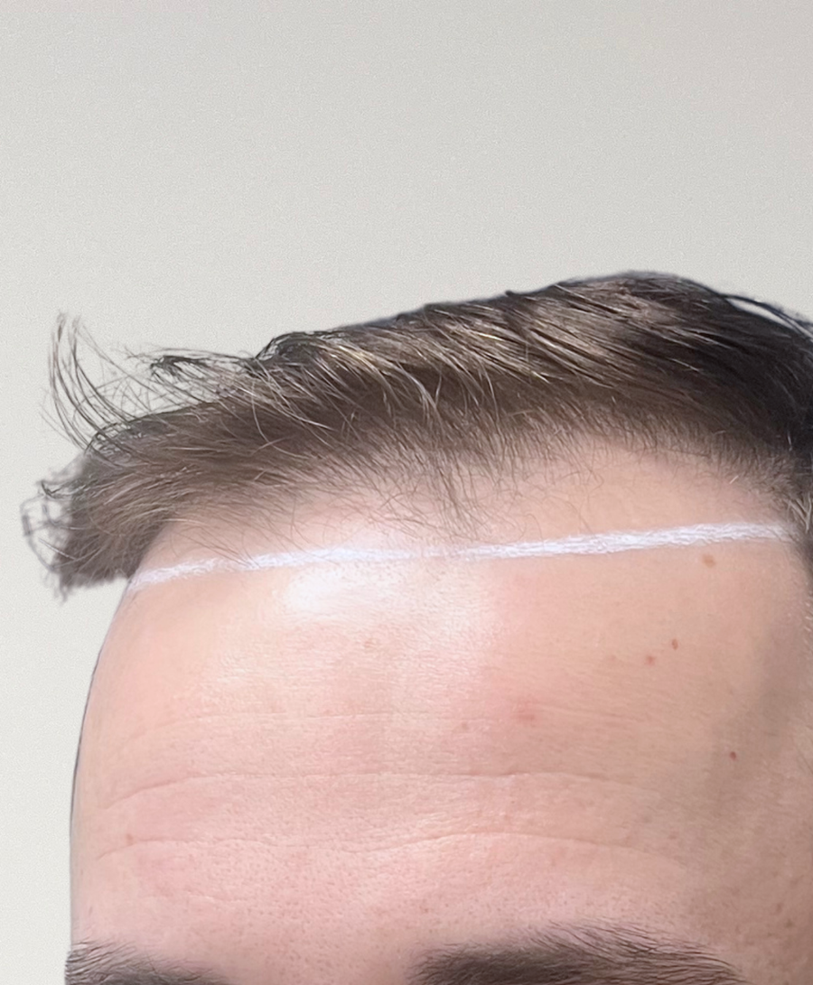 Hair restoration patient before treatment, age 25, receding hairline