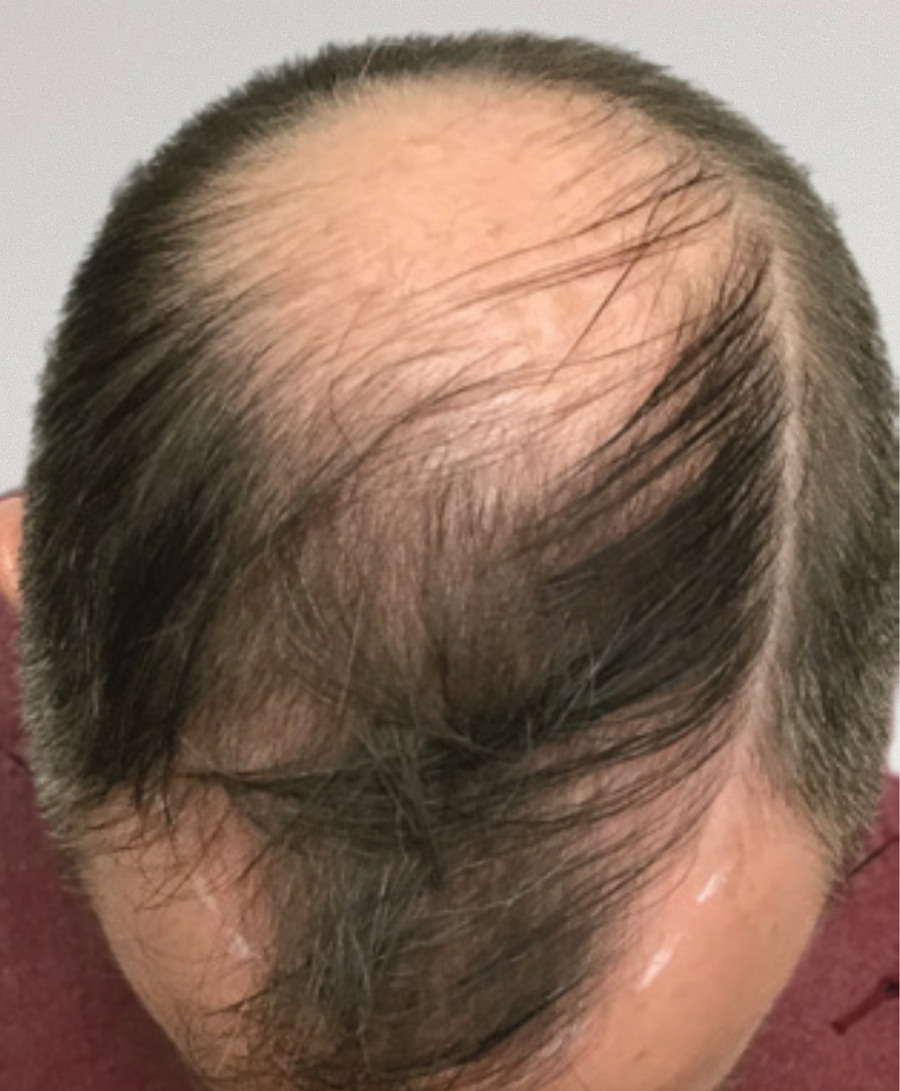 Hair restoration patient before treatment, thinning, balding