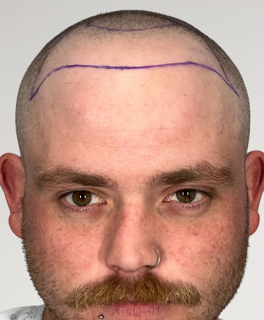 Hair restoration patient before treatment, age 29, receding hairline