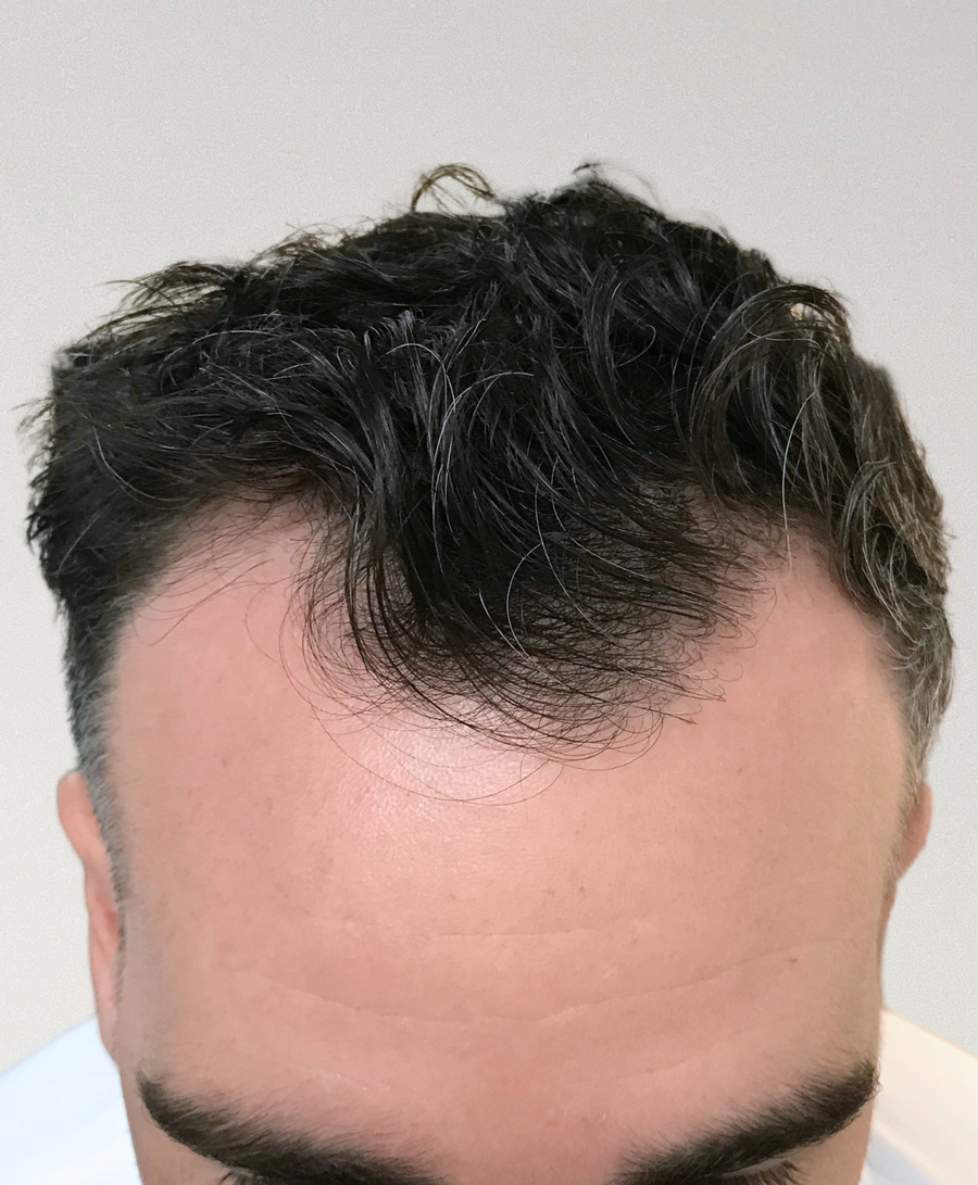 Hair restoration patient before treatment, age 41, receding hairline