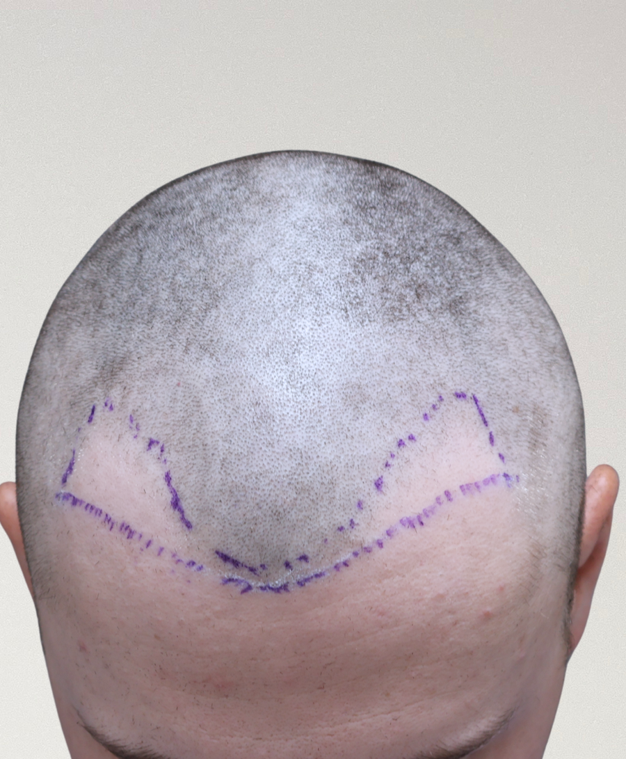 Hair restoration patient before treatment, age 25, receding hairline