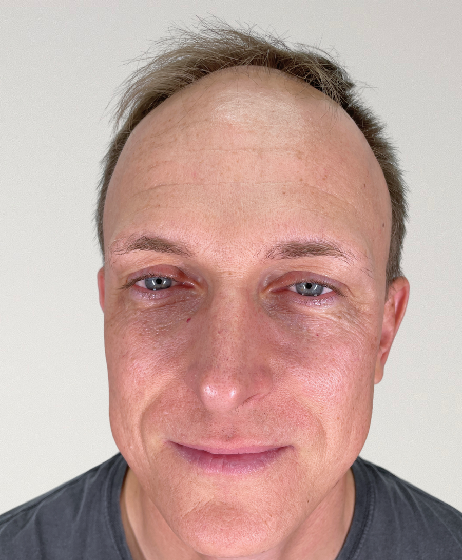 Hair restoration patient before treatment, age 45, receding hairline, thinning