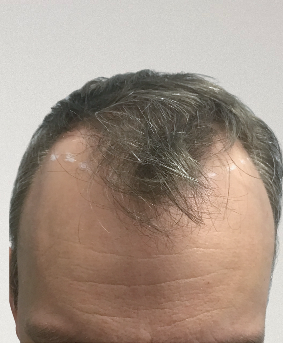 Hair restoration patient before treatment, age 48, receding hairline, thinning, balding