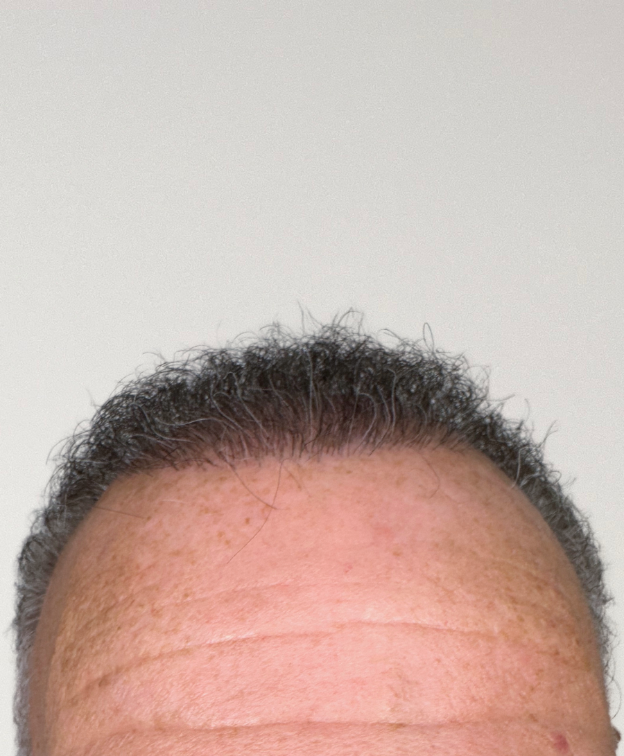 The same patient 12 months, treated by Dr Muchi Mandishona