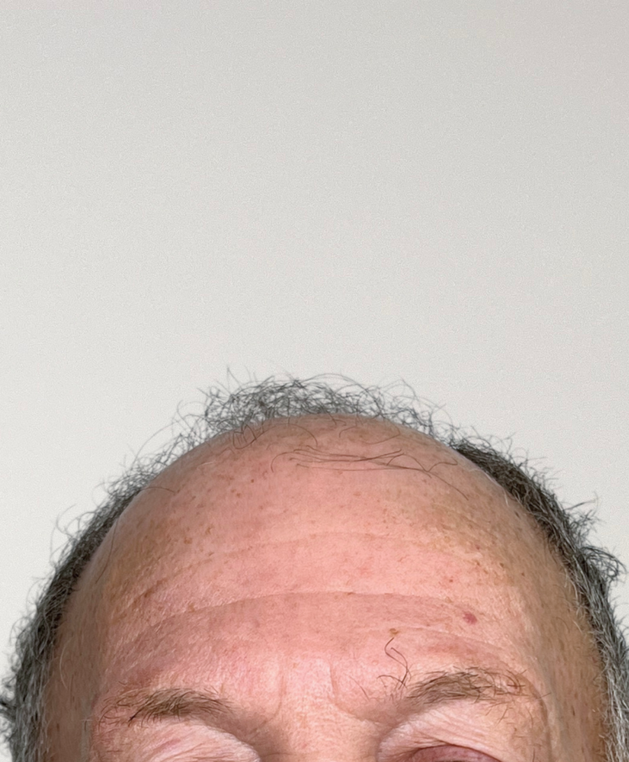 Hair restoration patient before treatment, age 76, balding