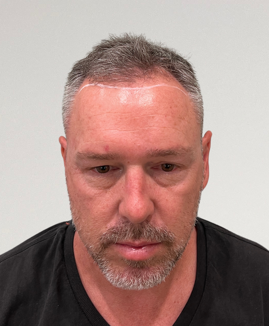 Hair restoration patient before treatment, age 46, receding hairline, thinning