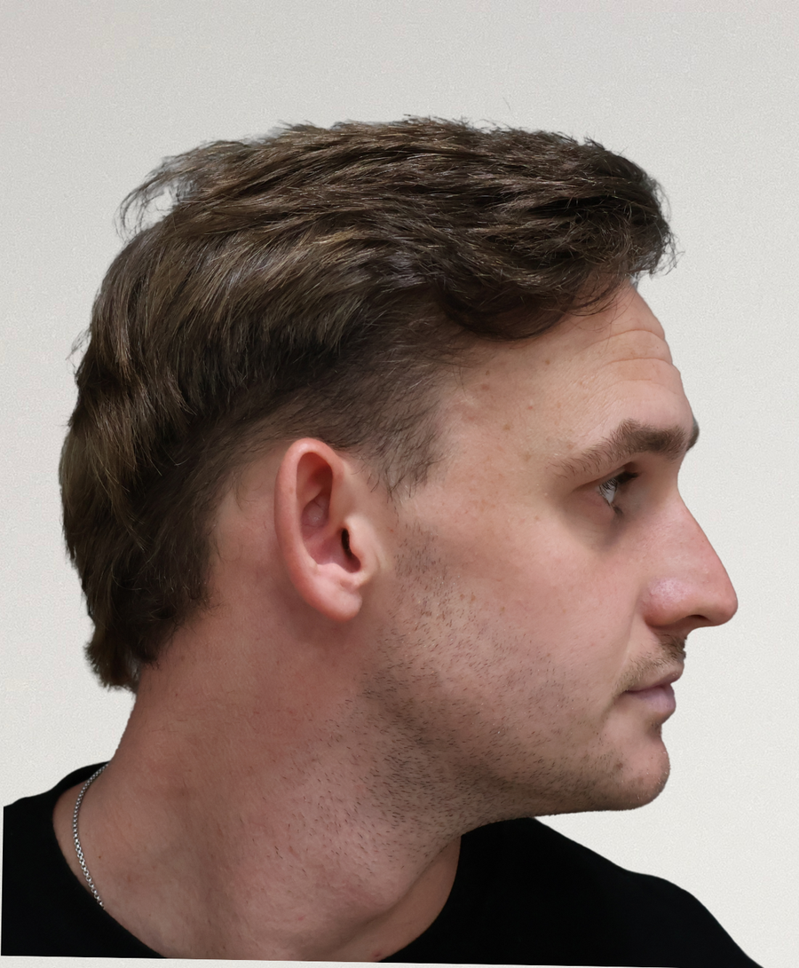 The same patient 12 months, treated by Dr David Ballantyne