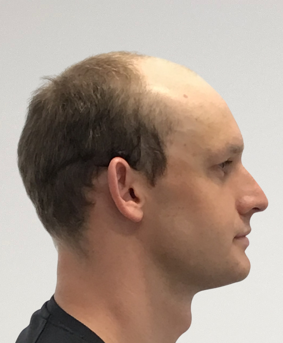 Hair restoration patient before treatment, age 26, receding hairline, balding