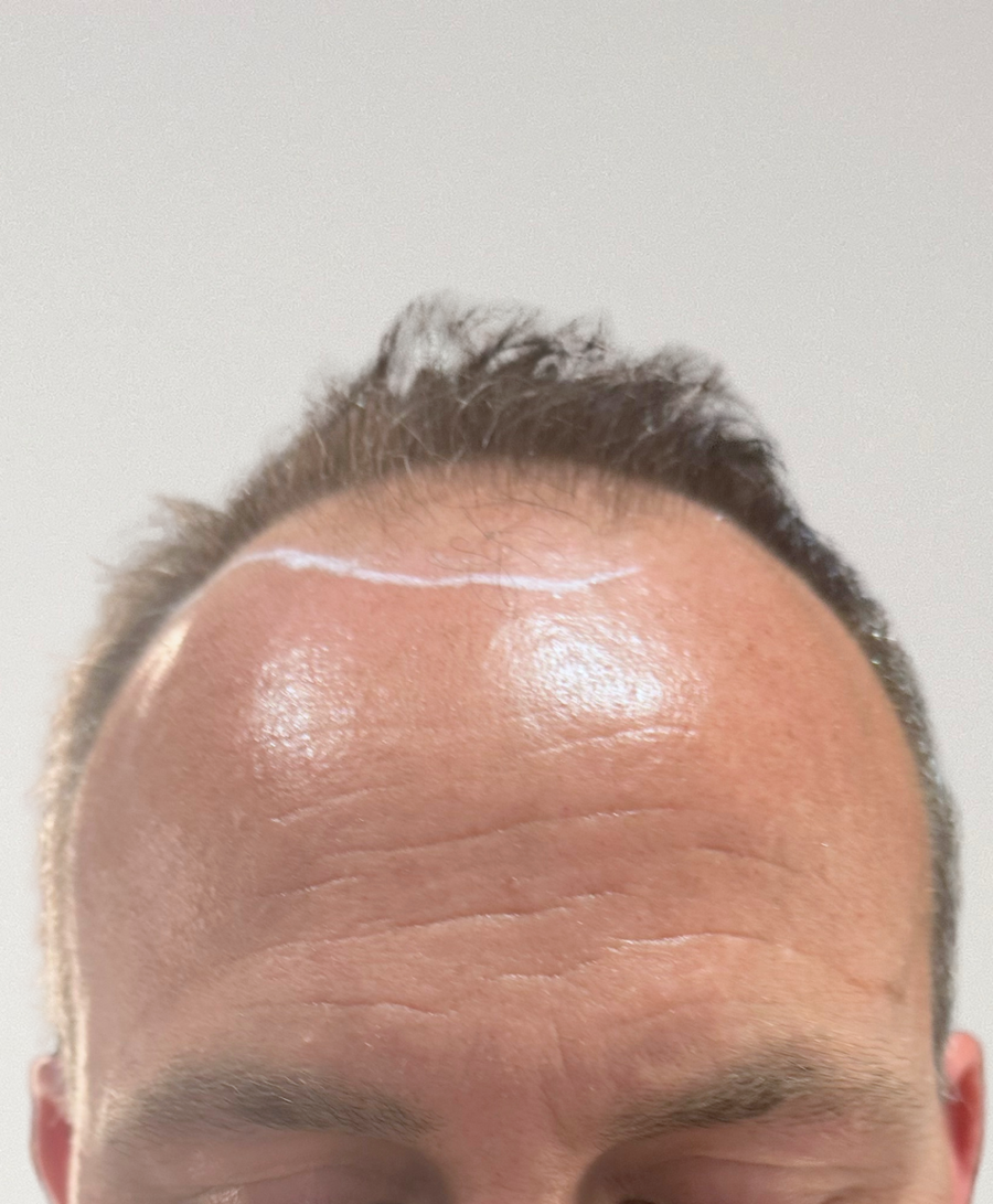 Hair restoration patient before treatment, age 41, receding hairline