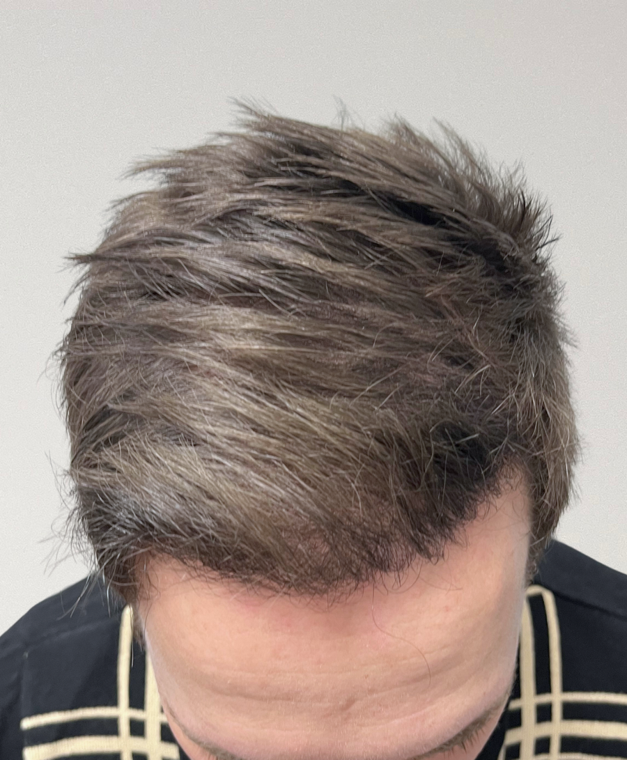 The same patient 6 months, treated by Dr Gamze Aksakal