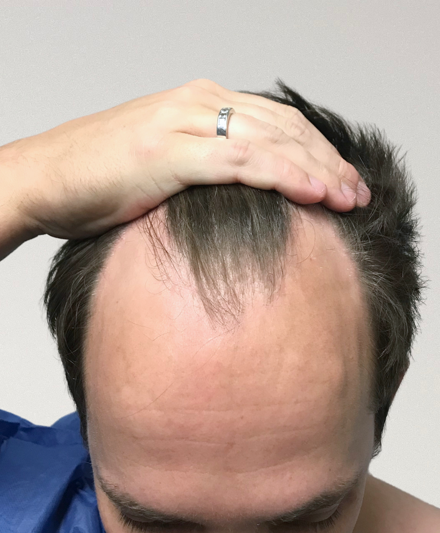 Hair restoration patient before treatment, age 34, receding hairline