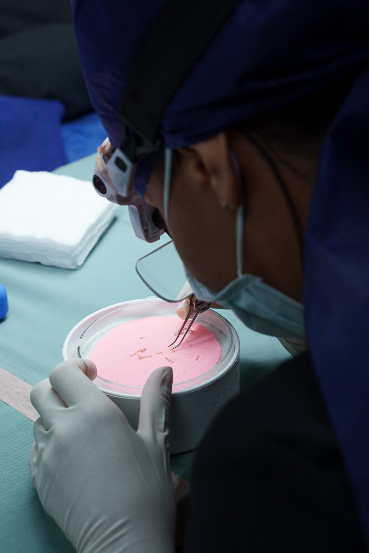 Grafts held in Hypothermosol solution during a Gro procedure