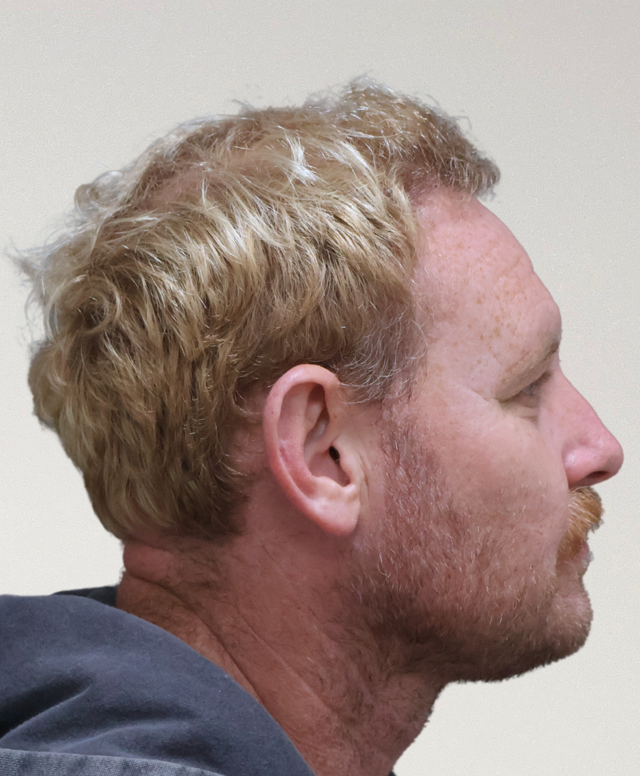 The same patient 6 months, treated by Dr David Ballantyne