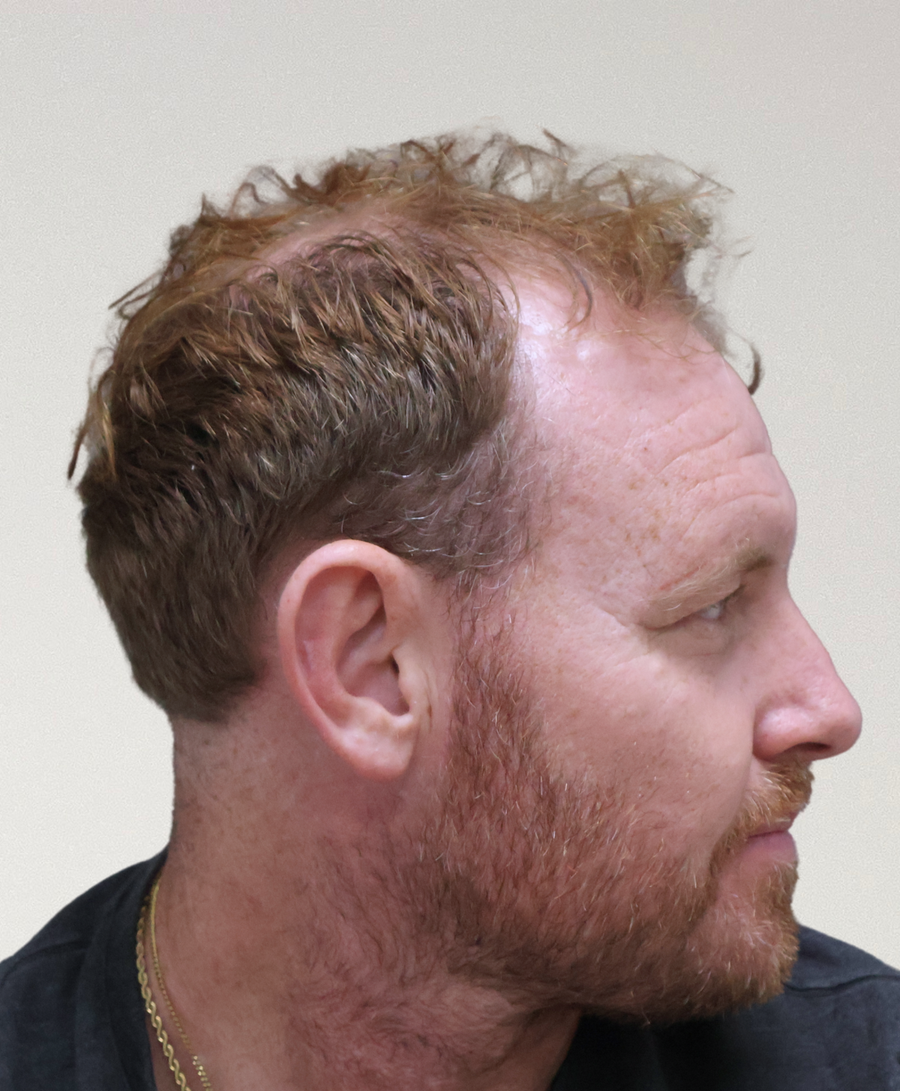 Hair restoration patient before treatment, receding hairline, thinning
