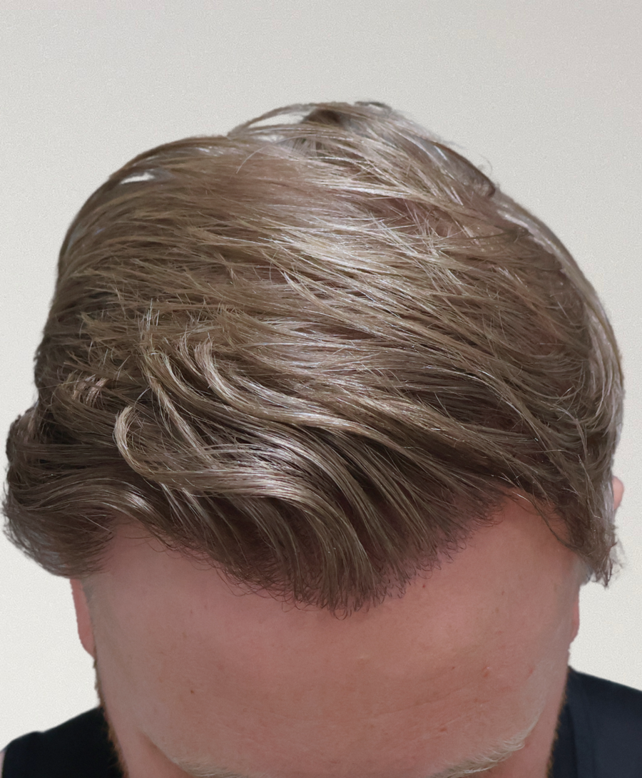 The same patient 12 Months, treated by Dr David Ballantyne