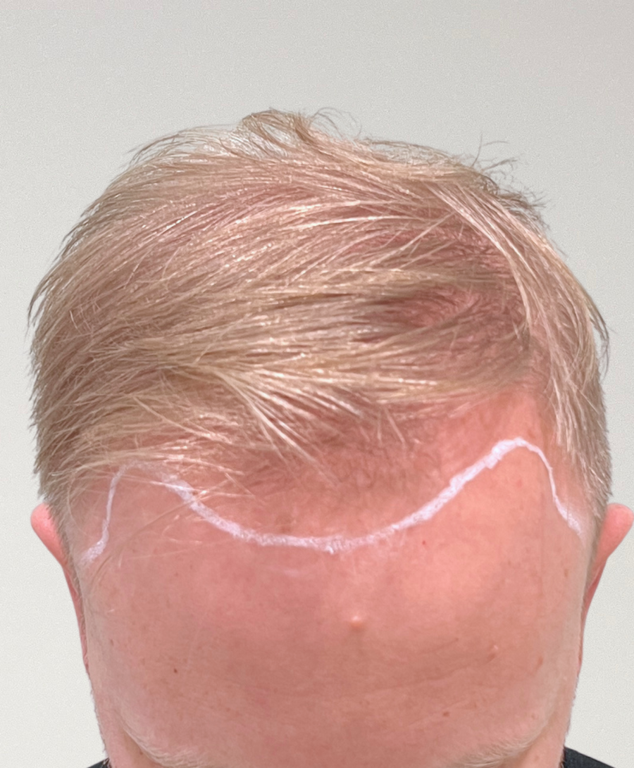 Hair restoration patient before treatment, thinning