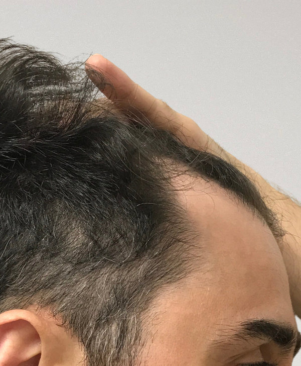before hair restoration