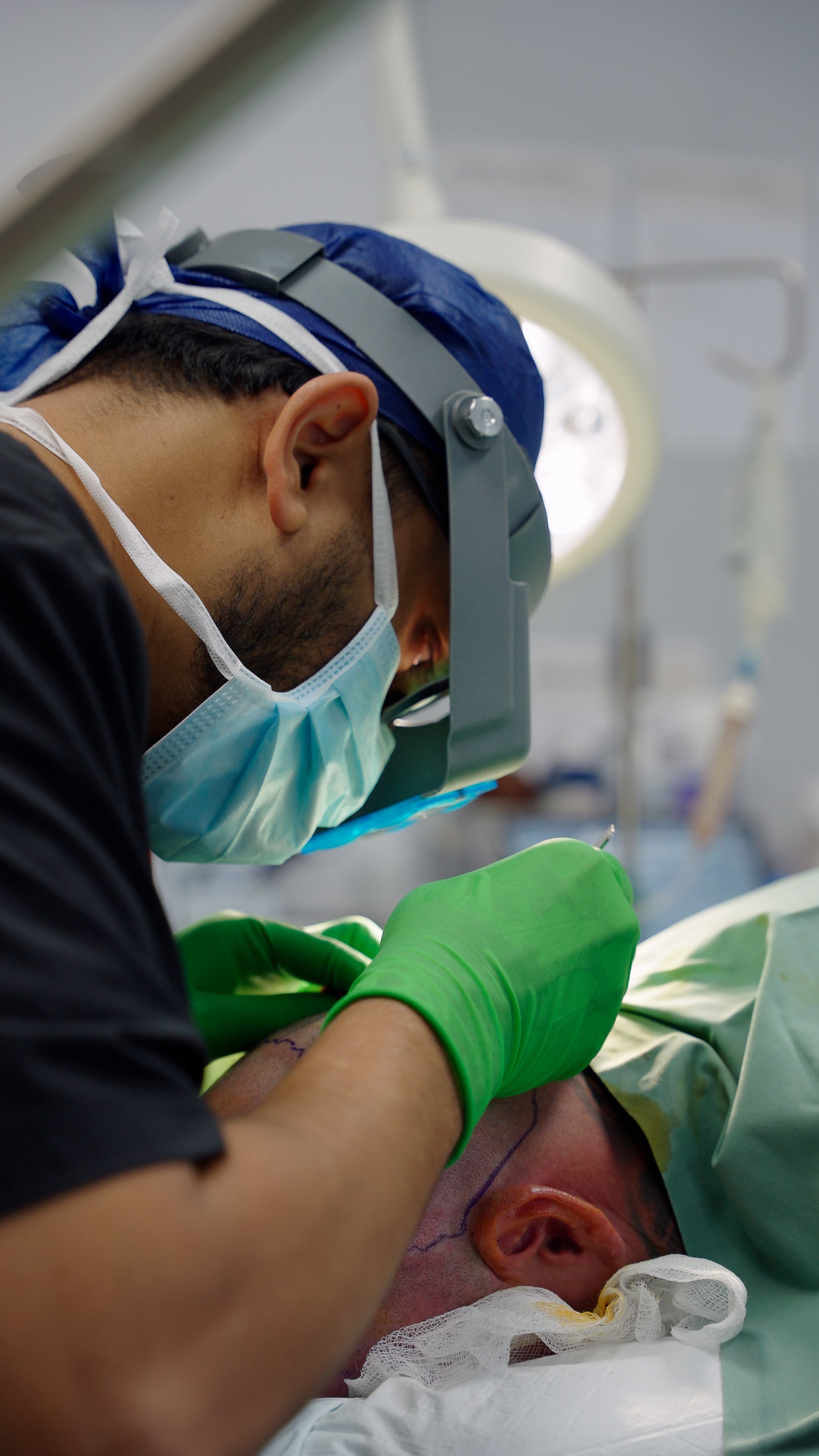 The Hair Transplant Timeline: What to Expect
