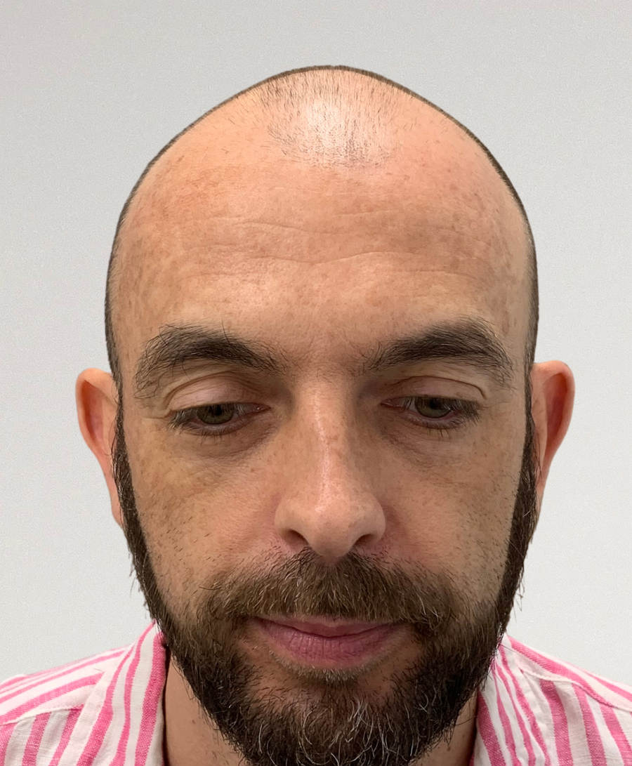 Hair restoration patient before treatment, receding hairline, balding
