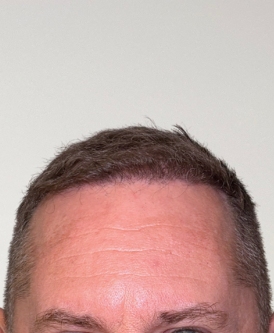 The same patient 6 months, treated by Dr Anwar Al-Abedi