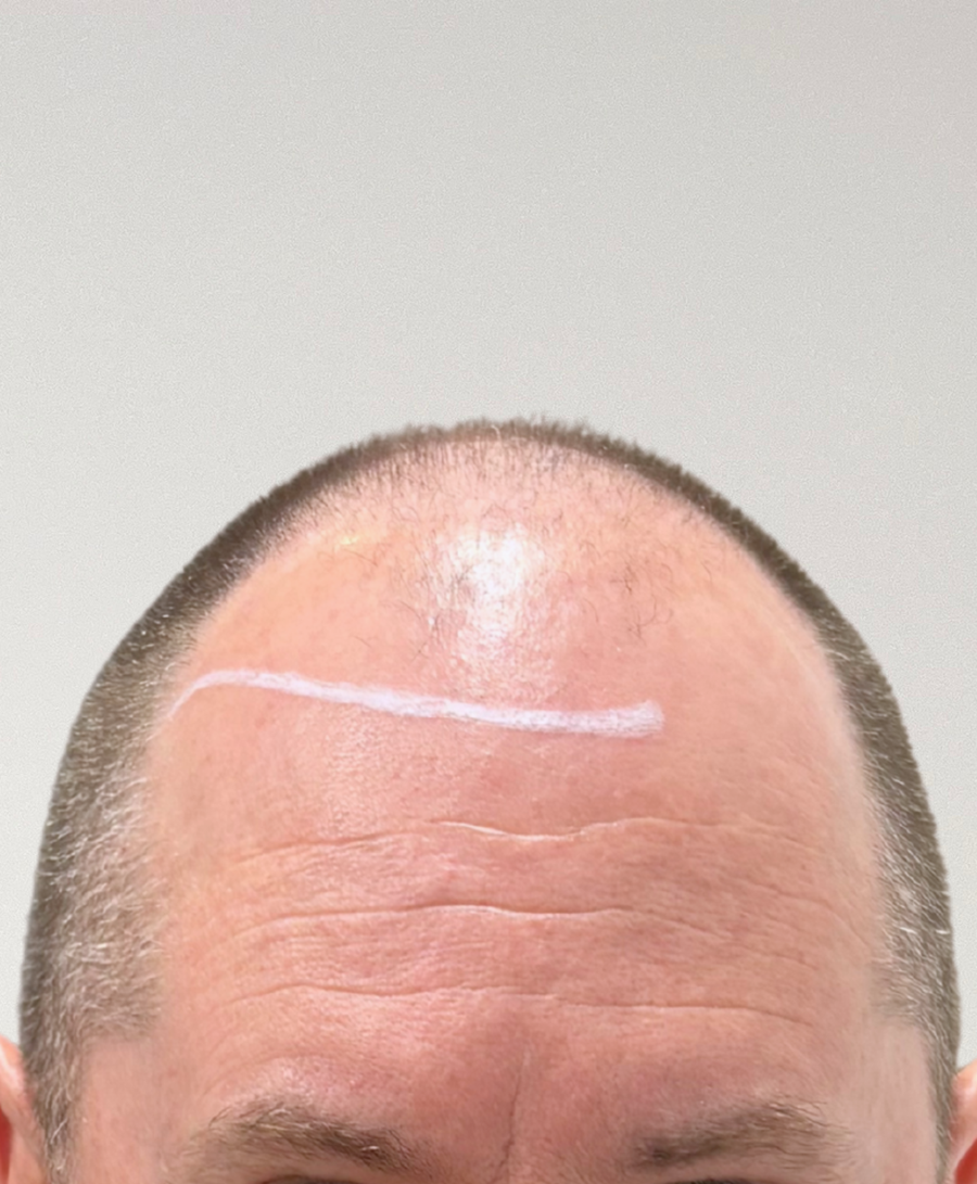 Hair restoration patient before treatment, age 48, balding