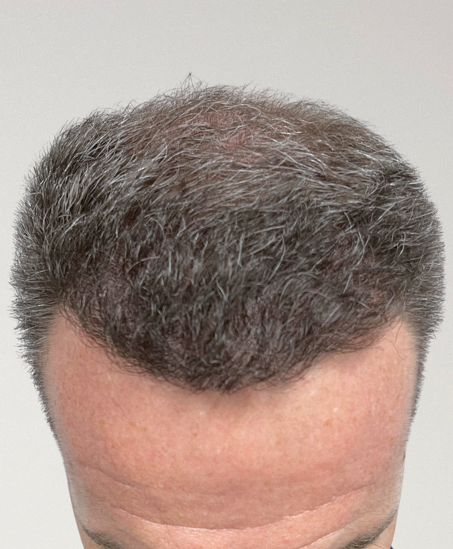 The same patient 9 Months, treated by Dr Hisham Khalid