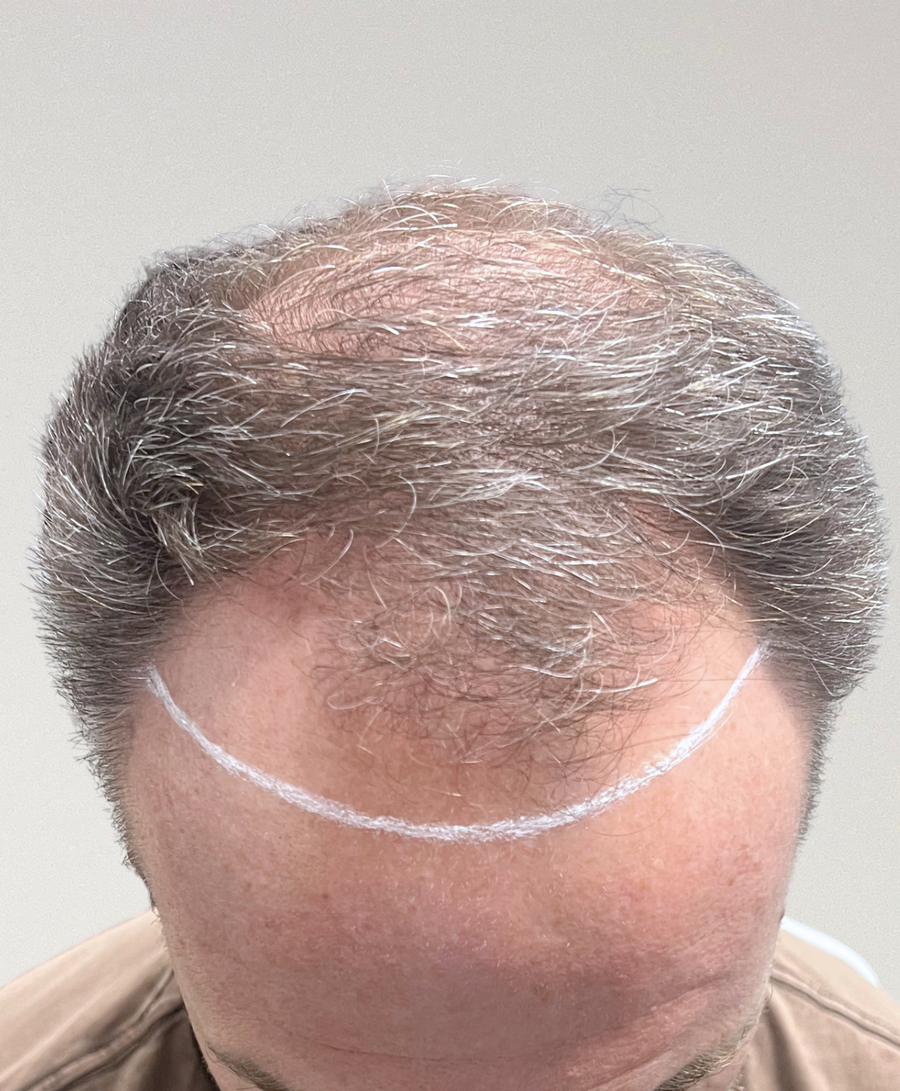 Hair restoration patient before treatment, age 54, receding hairline