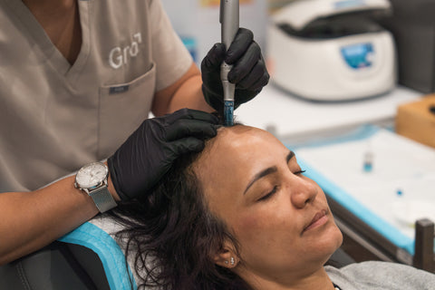 Scalp Microneedling