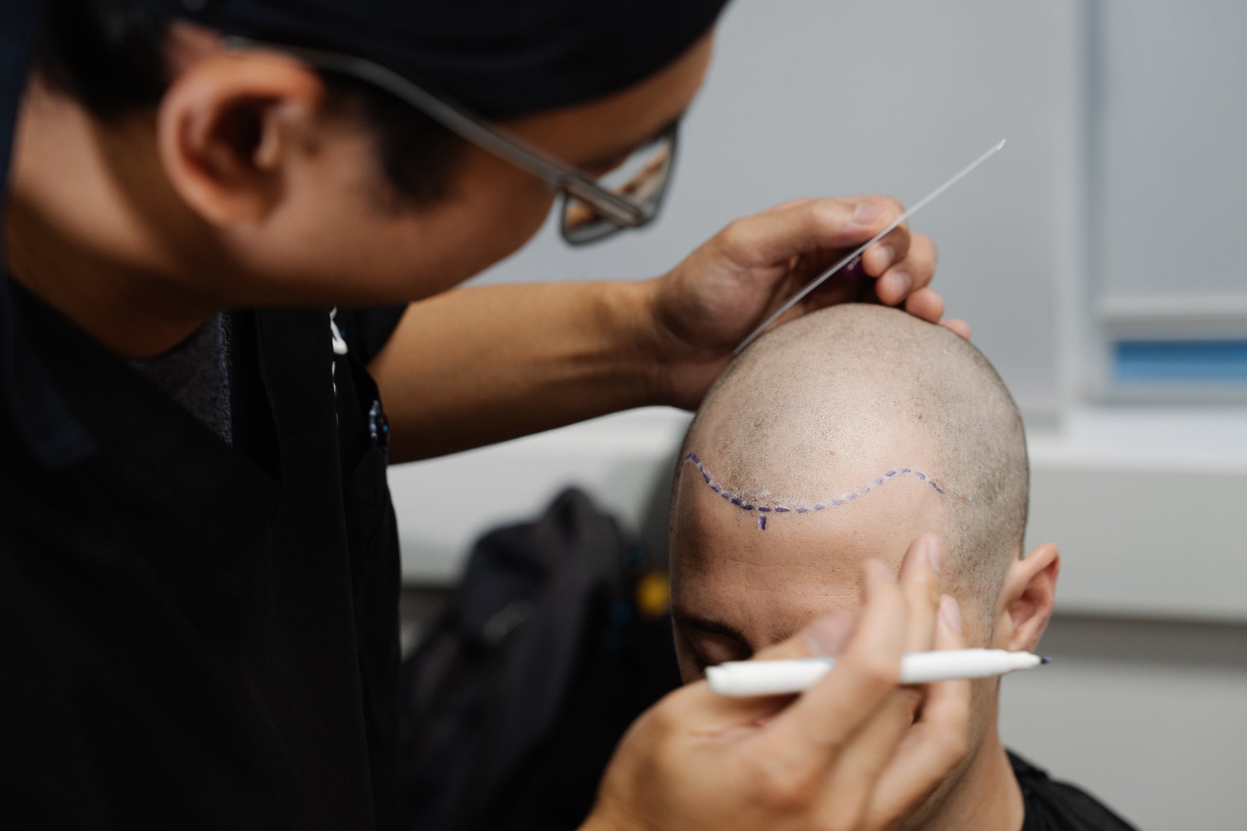 Every Hair Transplant Starts With a Personalised Plan