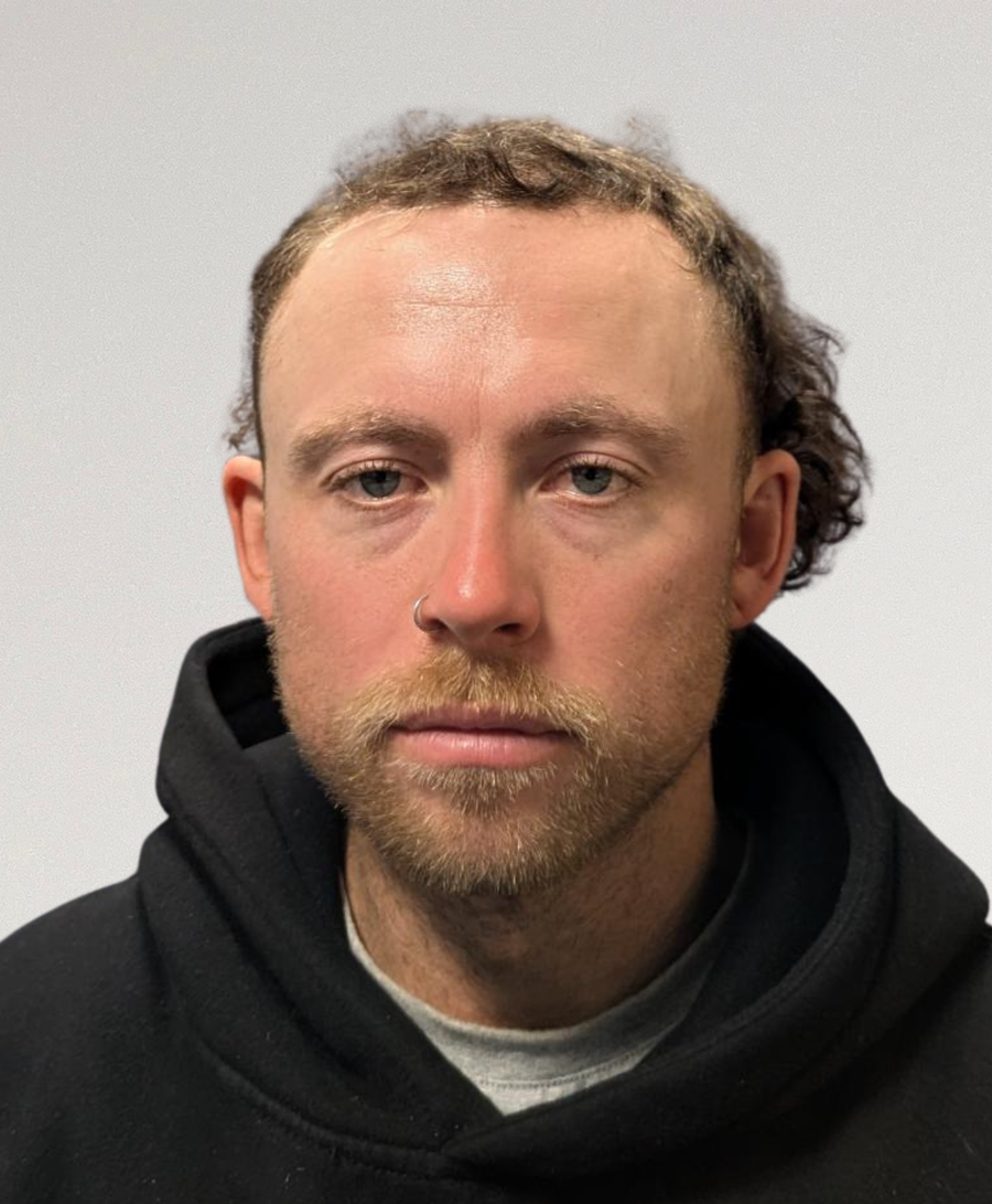 Hair restoration patient before treatment, age 32, receding hairline
