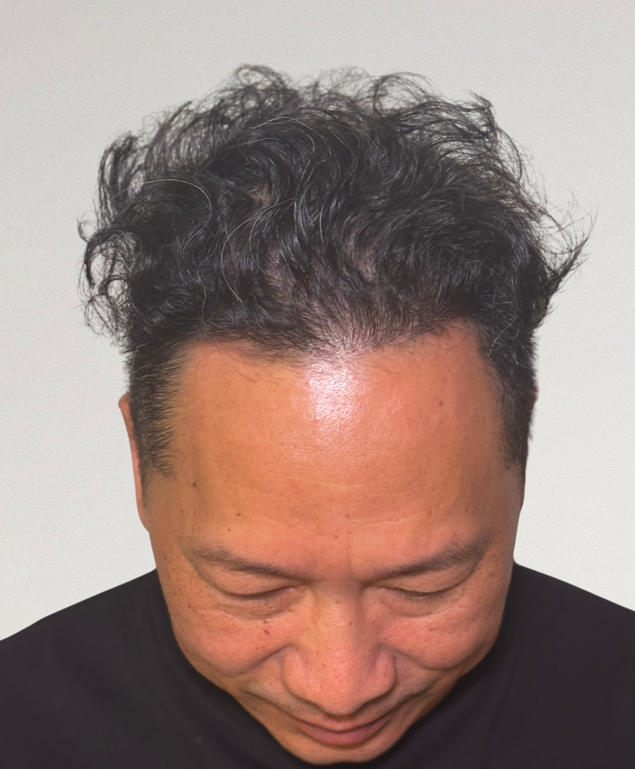 The same patient 18 months , treated by Dr Adam Cho