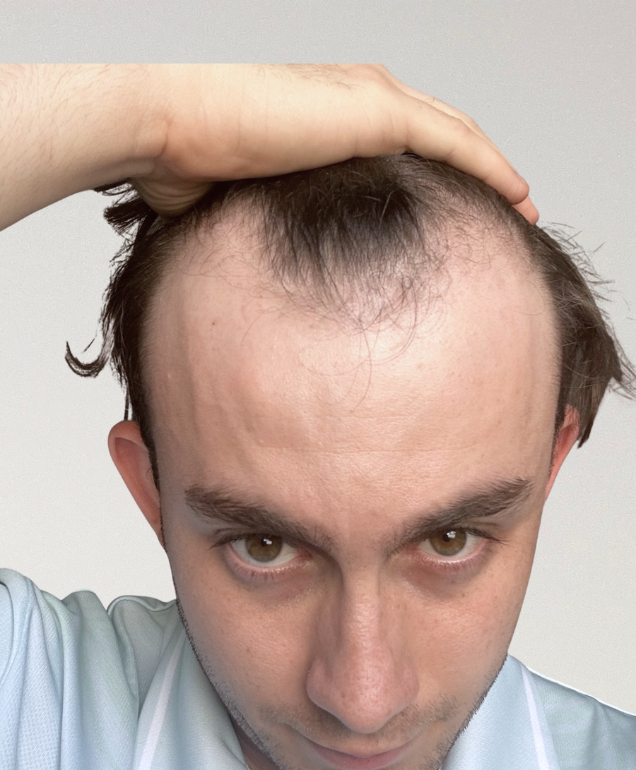 Hair restoration patient before treatment, age 24, receding hairline