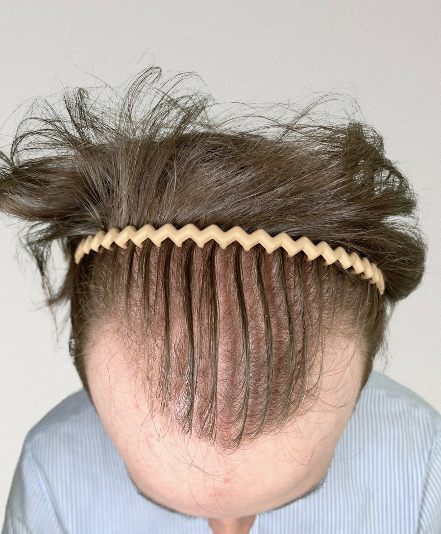 Hair restoration patient before treatment, age 31, receding hairline, thinning