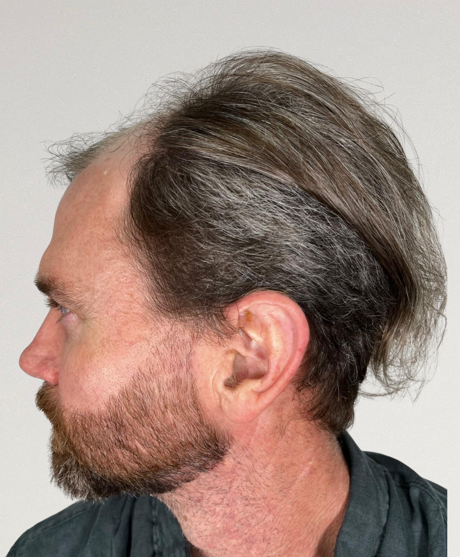 Hair restoration patient before treatment, age 46, thinning, balding