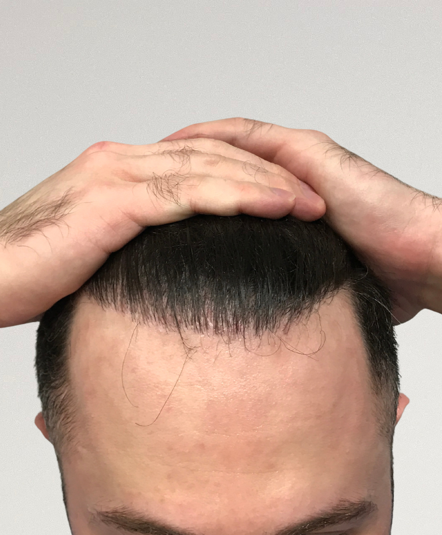 The same patient 12 months, treated by Dr Anwar Al-Abedi