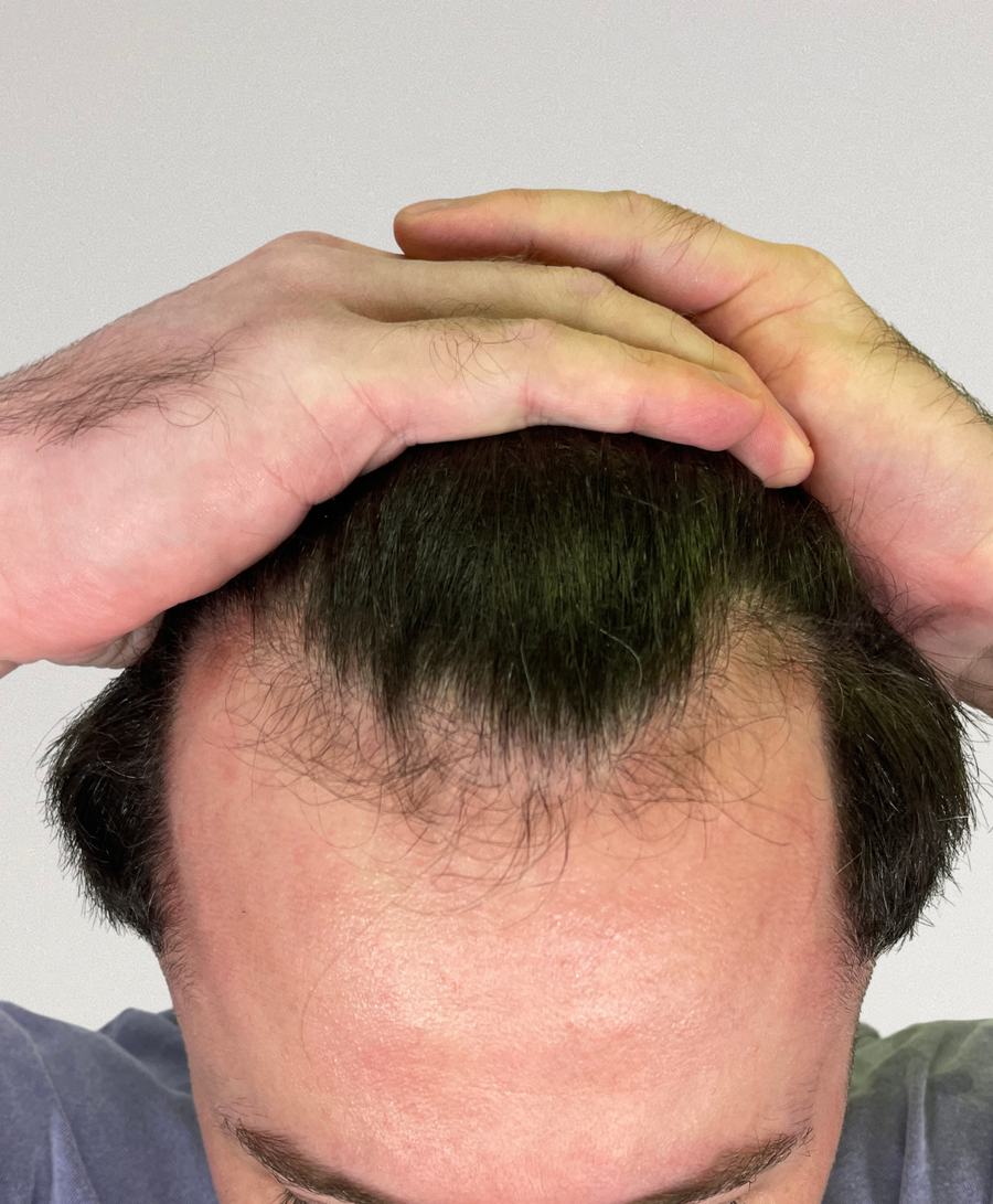 Hair restoration patient before treatment, age 32, receding hairline