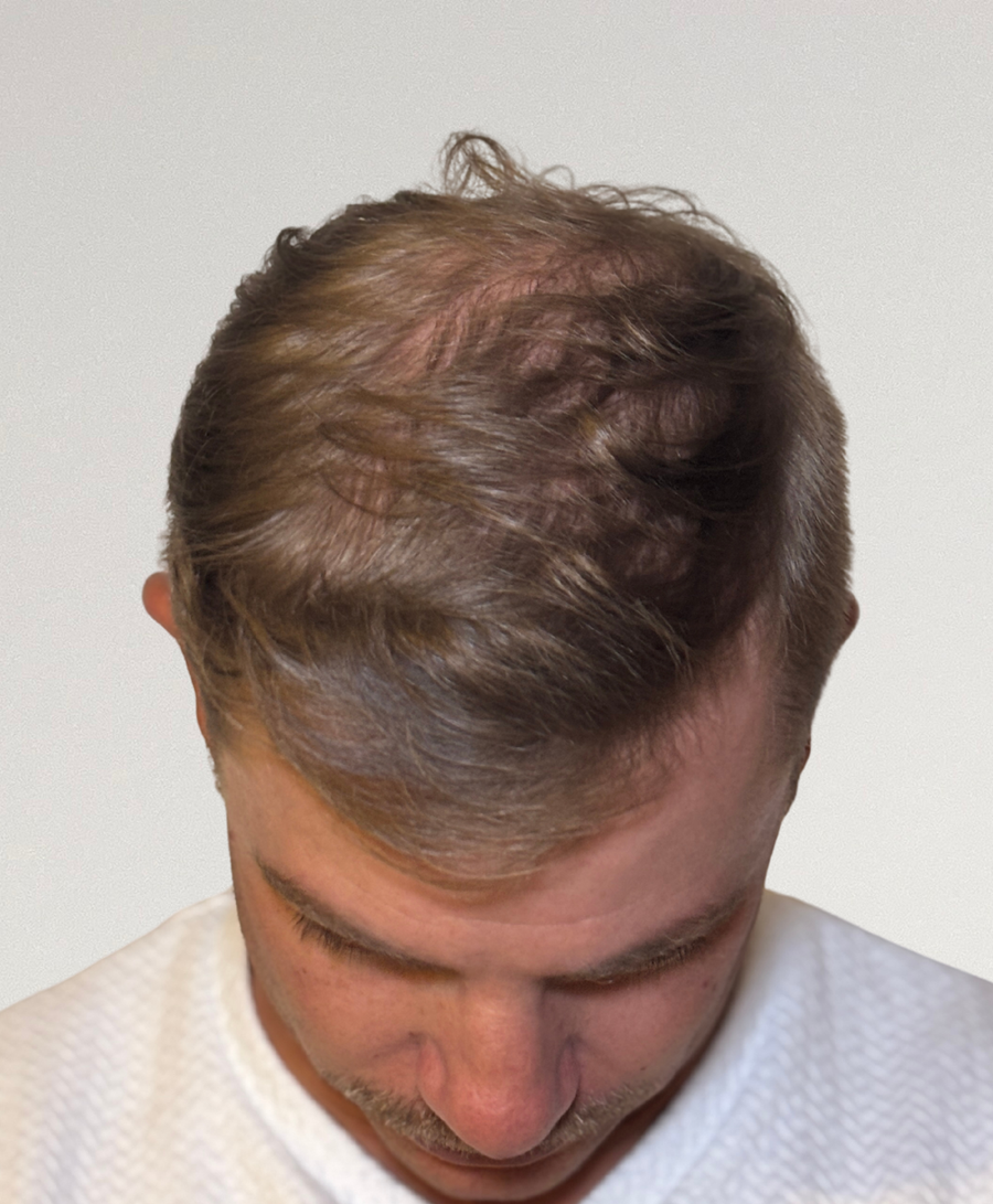 The same patient 6 months, treated by Dr Adam Cho